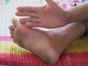 Chữa bệnh tê tay chân bằng thuốc vindermen