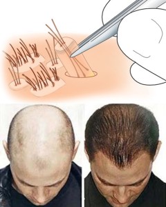 Những giải pháp trị rụng tóc hiệu quả cho nam giới