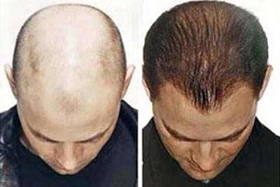 Cách chữa rụng tóc và chăm sóc tóc tốt nhất