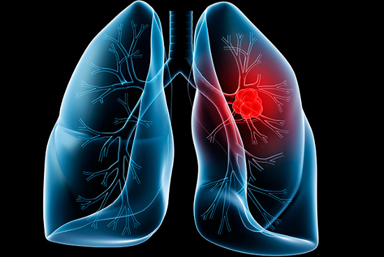Tổng quan về bệnh ung thư phổi