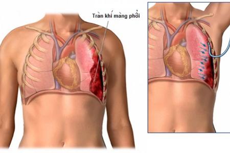Tràn khí màng phổi xảy ra khi có khí tràn vào giữa phổi