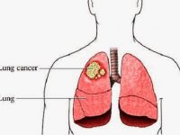 Bệnh ung thư phổi có chữa được không?