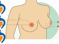 7 dấu hiệu giúp nhận biết bệnh ung thư vú sớm nhất