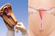 Đặt vòng tránh thai có tốt không – Giải đáp của các chuyên gia