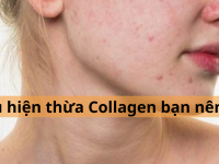 Biểu hiện thừa Collagen