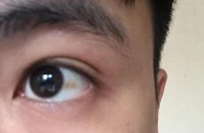 Dấu hiệu các bệnh về mắt