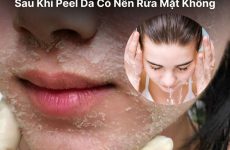 Sau Khi Peel Da Có Nên Rửa Mặt Không Hướng Dẫn Chi Tiết Và Lưu Ý