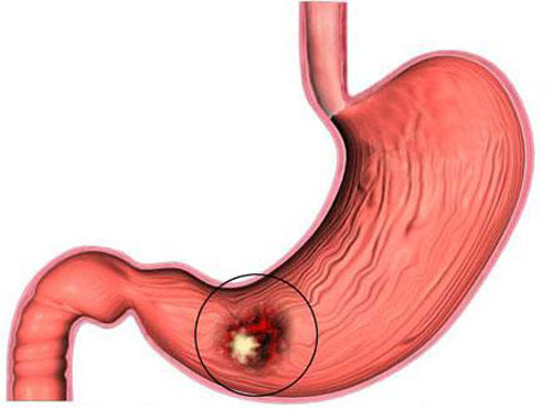 Bật mí bài thuốc trị viêm loét dạ dày – tá tràng