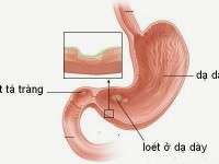 Tác dụng của Nấm lim xanh hỗ trợ chữa đau dạ dày, tá tràng