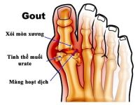 Bệnh gout có chữa được không? Làm thế nào để chữa hiệu quả?