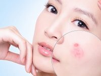 Chia sẻ bí quyết ngừa mụn ngày đèn đỏ hiệu quả đến bất ngờ