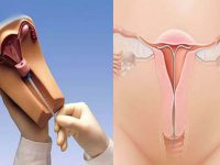 Đặt vòng tránh thai có tốt không – Giải đáp của các chuyên gia